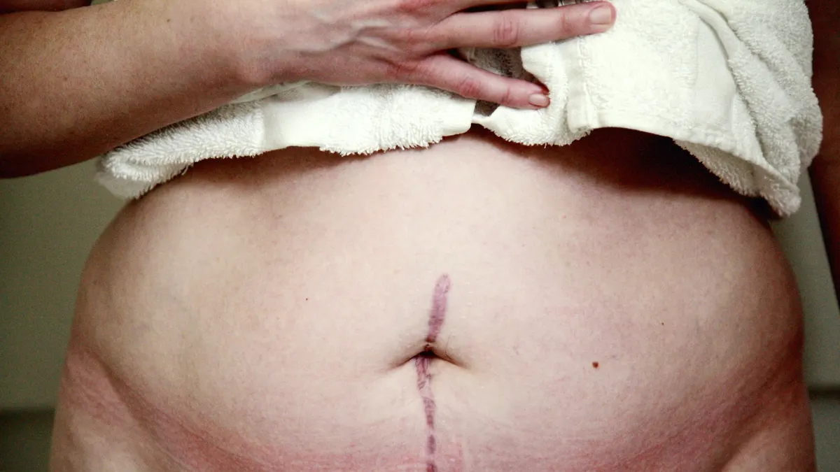 علامات التمدد (الستريا): لماذا تتشكل وماذا يمكن للعلاج أن يحققه فعلا